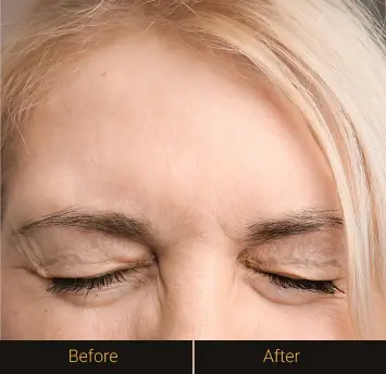 botox-b-after