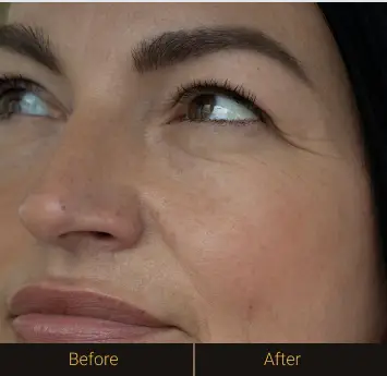 fillers-b-before